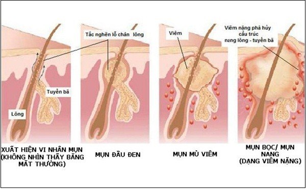 Mụn là gì? Mỹ phẩm Bạch Hoa Hồng có thể điều trị mụn như thế nào?