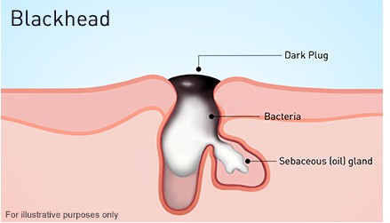 Mụn đầu đen