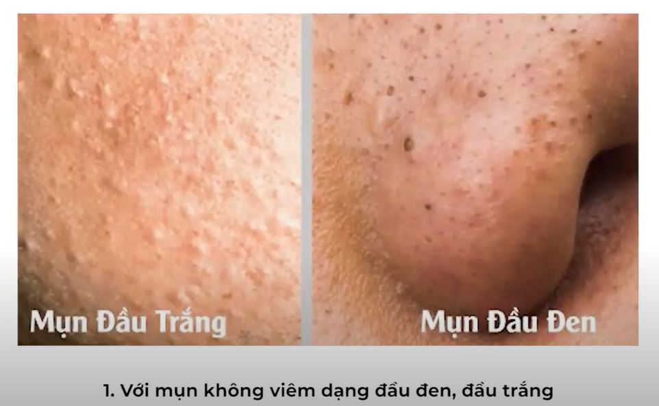 Mụn không viêm đầu trắng, đầu đen