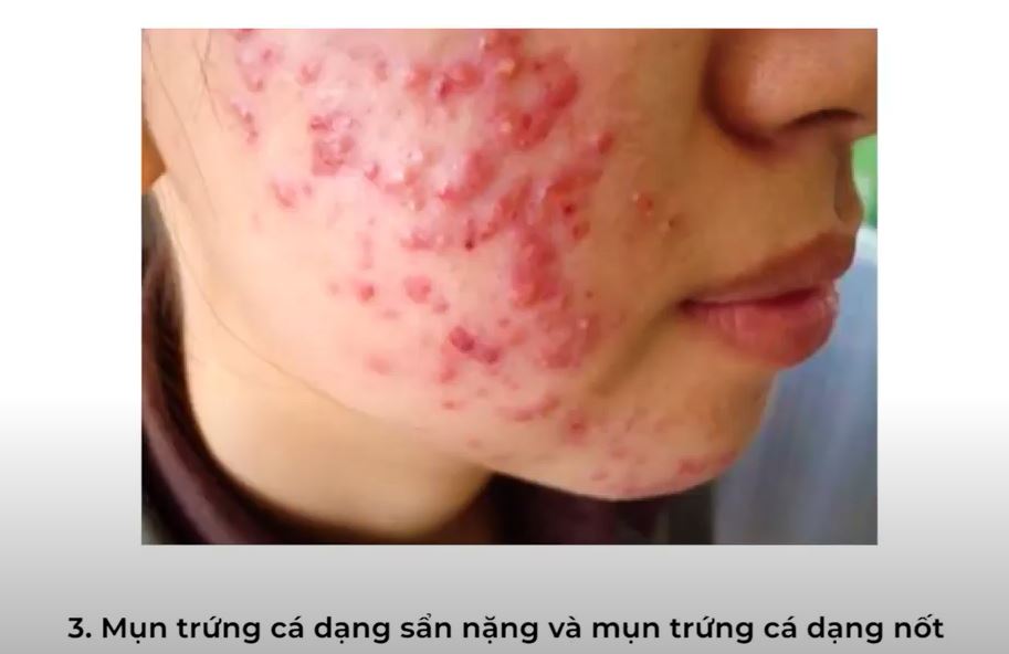 mụn sần nặng dạng nốt