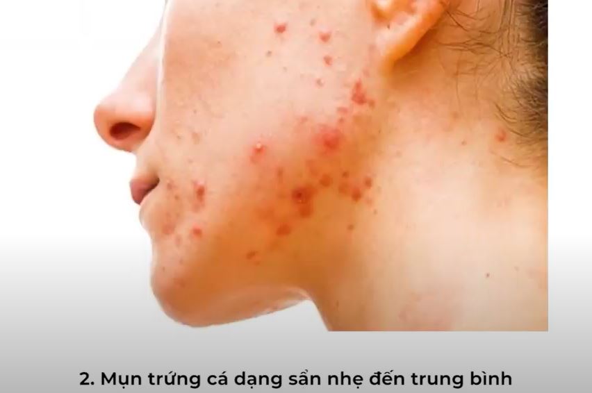 mụn sần nhẹ đến trung bình